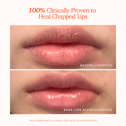 LipSoftie® Lip Treatment