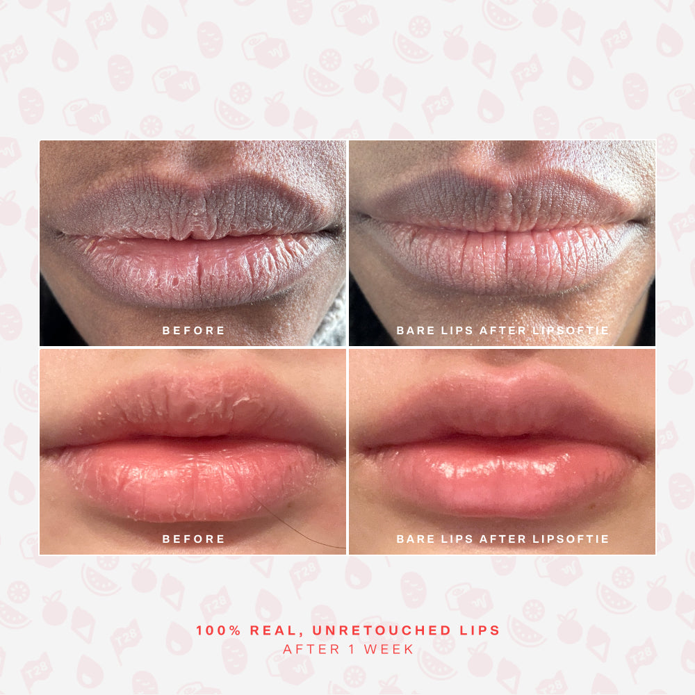 SOS LipSoftie® Lip Treatment